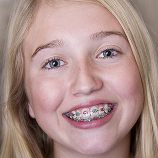 orthodontic faqs